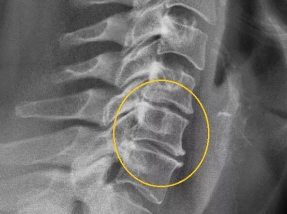 Osteochondrose der Halsspalte in einer X -Linie