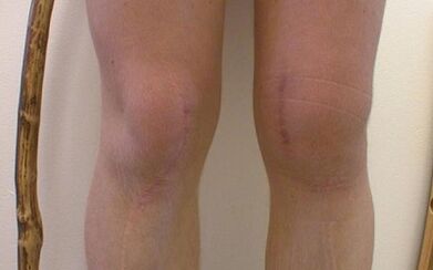 Stadien der Entwicklung der Knie -Arthrose
