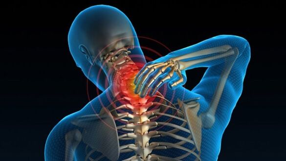 Schmerzen beim Drehen des Halses können auf ein Wirbelsyndrom der zervikalen Osteochondrose hinweisen