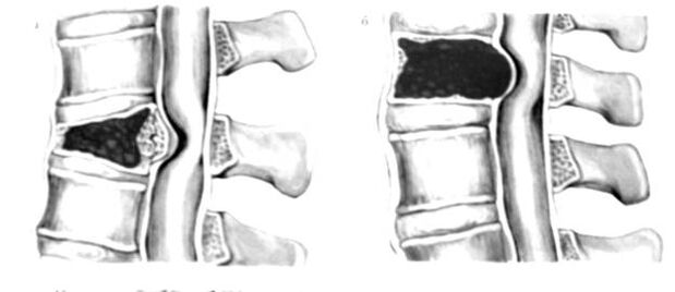 Der Tumor in der Säule ist die Ursache von Rückenschmerzen