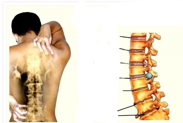 Osteochondrose ist die Ursache für Rückenschmerzen